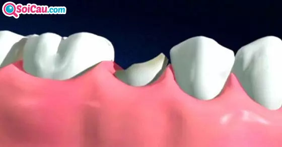 Giải mã giấc mơ gãy răng có điềm báo gì?