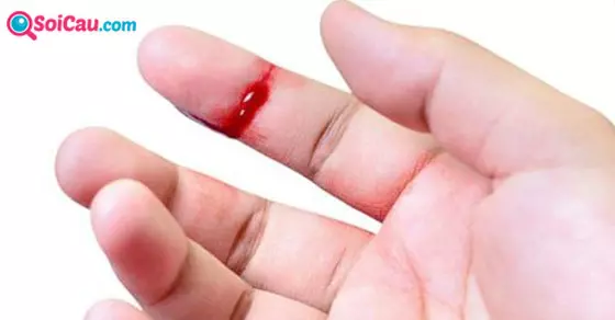 Mơ chảy máu tay, chân đánh số gì?