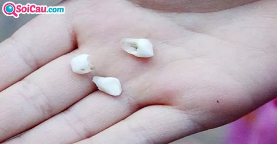 nằm mơ thấy gãy răng đánh con gì?