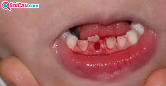 Mơ thấy gãy răng là điềm gì?