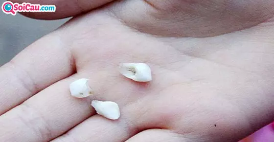 Mơ thấy rụng răng là điềm gì?